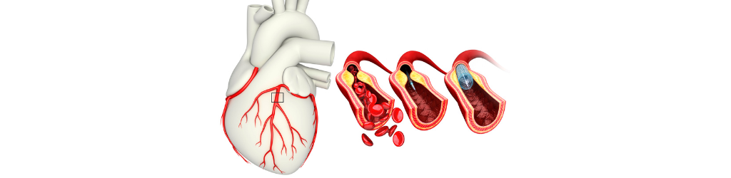 Cardiovascular health, Clogged Arteries Prevention Healthy Heart,