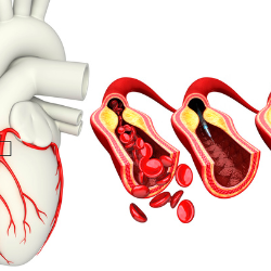 Cardiovascular health, Clogged Arteries Prevention Healthy Heart, 