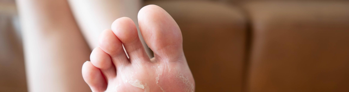 Foot Fungal Infection Woes During Monsoon: Simple Home Remedies For Effective Relief