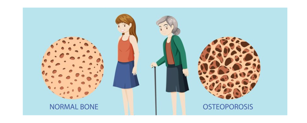 Strong Bones Care Tips Osteoporosis Day Dr Trust PNG 