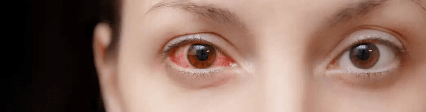 Eye Flu / Conjunctivitis Surge Alert: Identifying and Managing Symptoms - Dr Trust