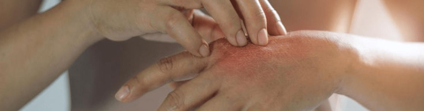 What Does Epsom Salt Do To Bacterial And Fungal Infection? - Dr Trust